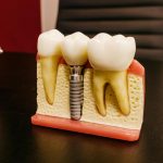 dental implants with screw on table in clinic